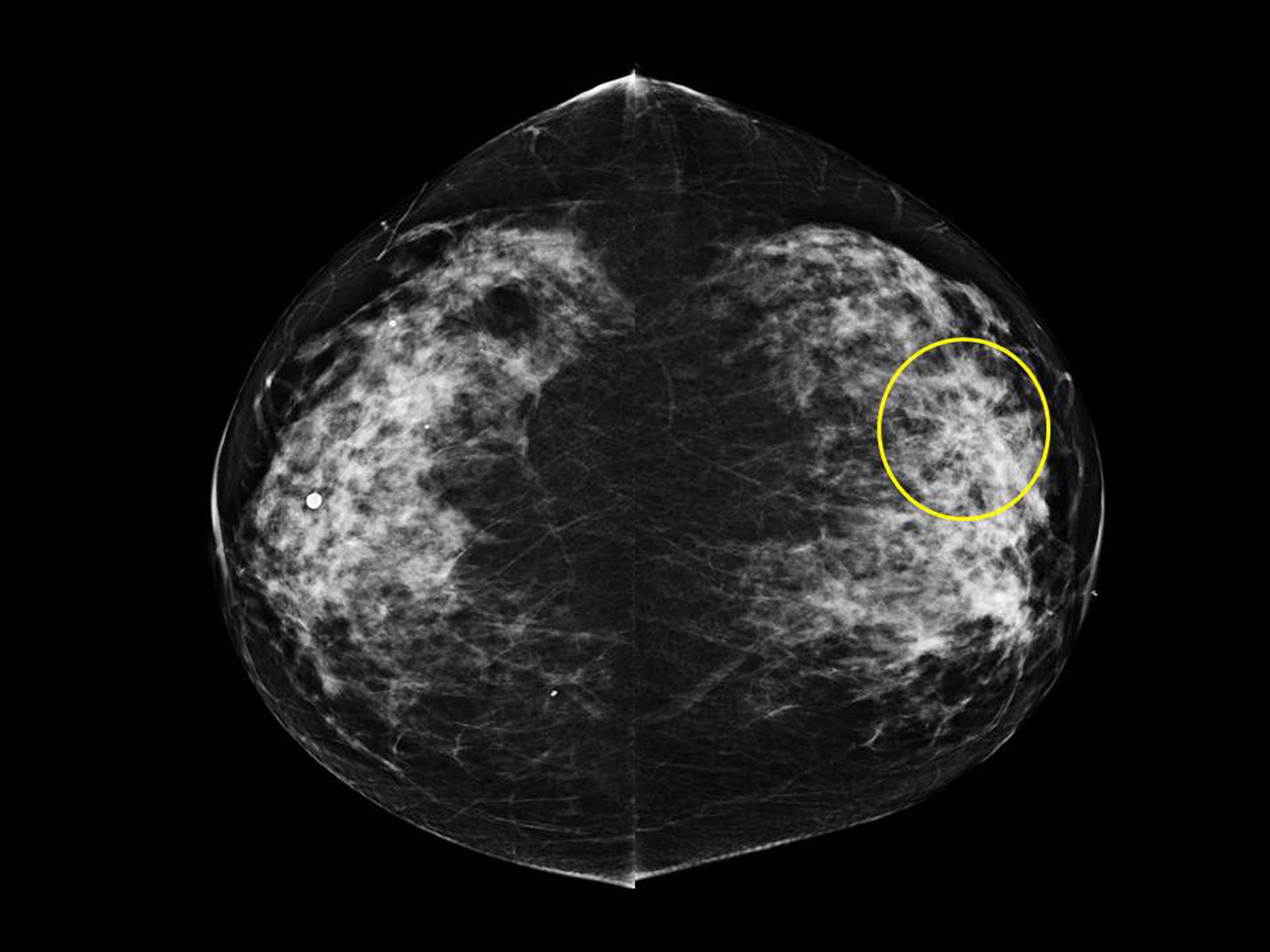 RSNA 2013 Breast Cancer Prognosis Potentially Affected by Screening